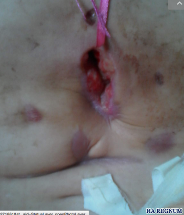 Раны на теле девушки их алтайского села Солтон, которая уже 2 года скитается по больницам