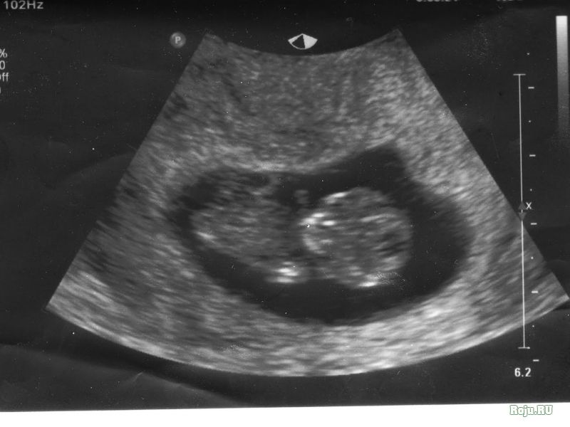 10 Недель Беременности Фото Узи Ребенка