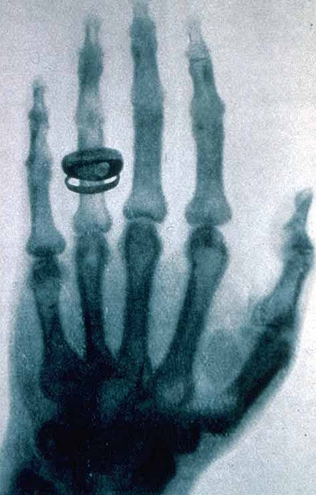 Снимок руки Альберта фон Кёлликера, сделанный Рентгеном 23 января 1896 года