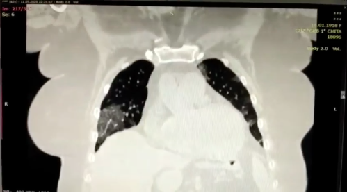«Цитокиновый шторм»: забайкальский врач показал лёгкие умершего от COVID-19