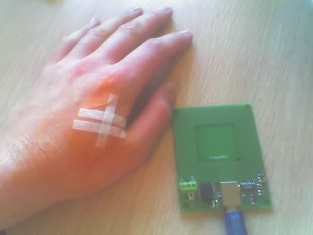 Имплантат в руку RFID 